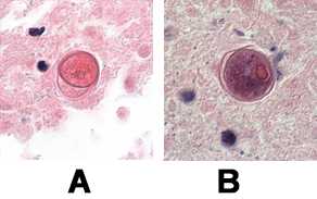 Balamuthia cysts under HE