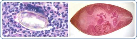 Left: Eggs of Paragonimus sp. taken from a lung biopsy stained with hematoxylin and eosin (H&E). These eggs measured 80-90 µm by 40-45 µm. The species was not identified in this case. Right: P. westermani adult, this approximately 1cm long fluke is viewed under magnification.