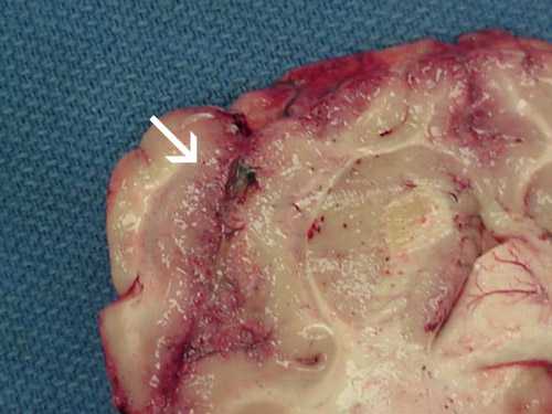 Focal hemorrhage and necrosis in frontal cortex due to Naegleria fowleri