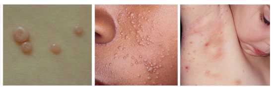 Images of Molluscum Contagiosum