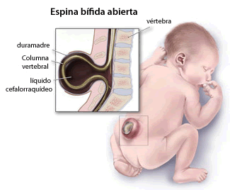 Gráfico: Espina bífida abierta