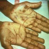 手掌梅毒二期皮疹。