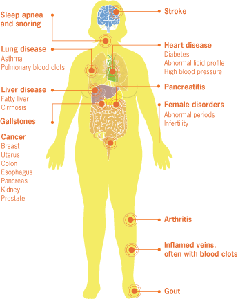 	Graphic: Medical Complications of Obesity - Obesity affects many body parts:  brain (stroke); throat (sleep apena, snoring); lungs (lung disease, asthma, pulmonary blood clots); heart (heart disease, diabetes, abnormal lipid profile, high blood pressure); liver (liver disease, fatty liver, cirrhosis); pancreas (pancreatitis); gall bladder (gallstones); uterus (female disorders, abnormal periods, infertility); knees (arthritis); calves (inflamed veins, often with blood clots); feet (gout); breast, uterus, colon, esophagus, pancreas, kidney, prostate (cancer).