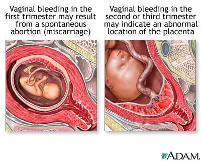 Vaginal bleeding during pregnancy