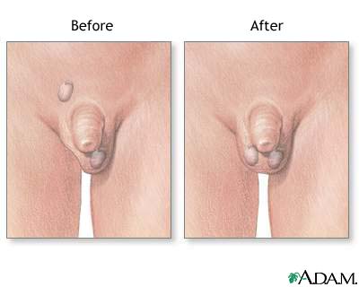 Before and after testicular repair