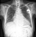 Xray-pacemaker.jpg