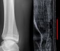 Achilles tendon rupture.jpg