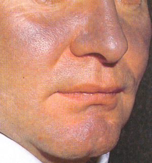 Amiodarone hyperpigmentation.jpg