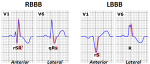 Bundle Branch Block.png