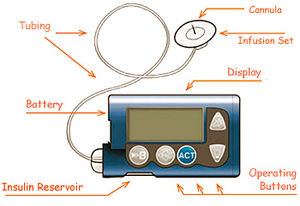 InsulinPumpALIEM.jpg