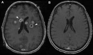 Ring enhancing lesion on MRI.png