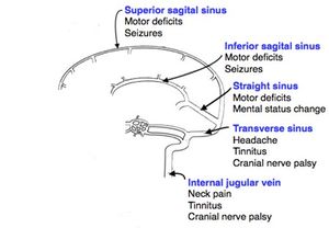 Sinus thrombosis.jpg