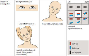 Trochlear nerve palsy.jpg