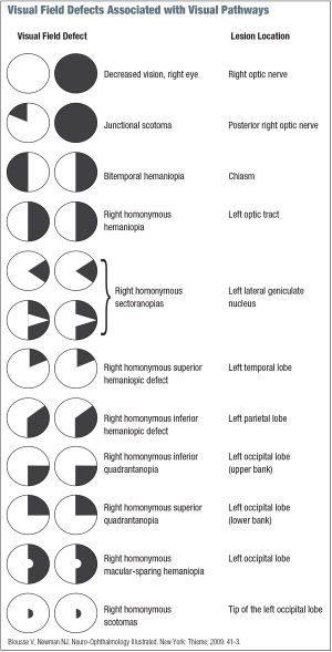 Visual-field-defect.jpg