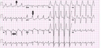 LBBB.jpg