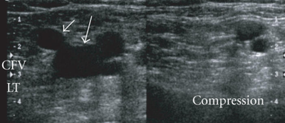 Compression at the Level of the Femoral Vein