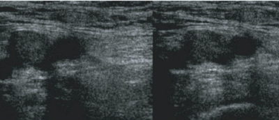 DVT of the Femoral Vein