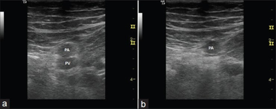 Compression at the Level of the Popliteal Vein