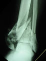 Pilon fracture.jpg