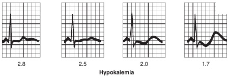 ECG Hypokalemia.jpg