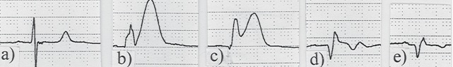 STEMI Progression.jpg