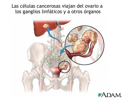 Metástasis de cáncer ovárico