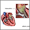 Endocarditis de cultivo negativo