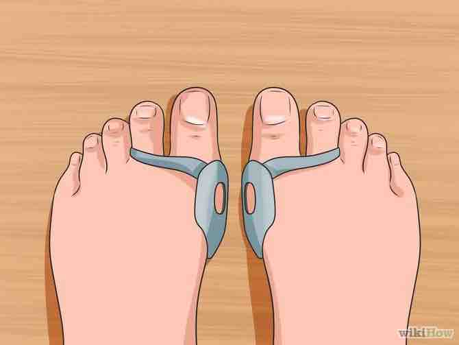 Imagen titulada Get Rid of Bunions Step 5