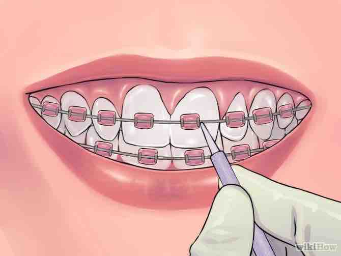 Imagen titulada Deal with Braces Step 10