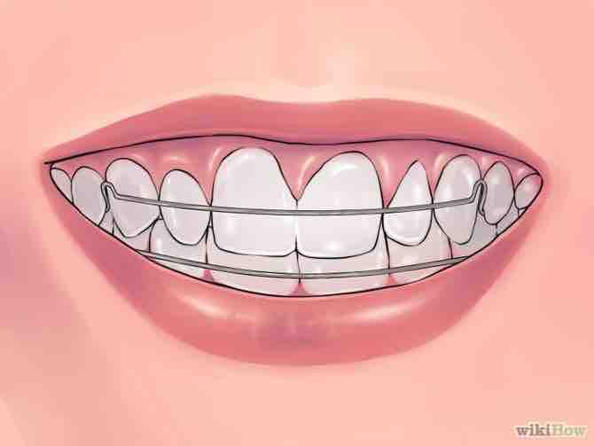 Imagen titulada Deal with Braces Step 17