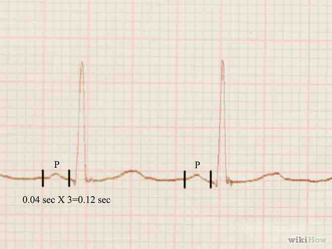 Imagen titulada Read an EKG Step 3