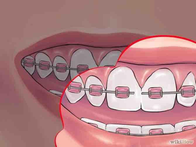 Imagen titulada Deal with Braces Step 15