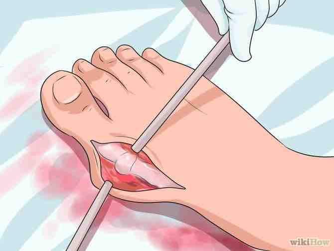 Imagen titulada Get Rid of Bunions Step 11