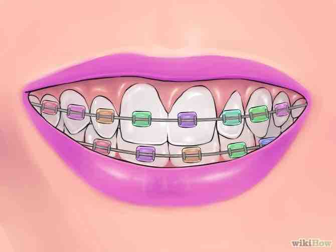 Imagen titulada Deal with Braces Step 19