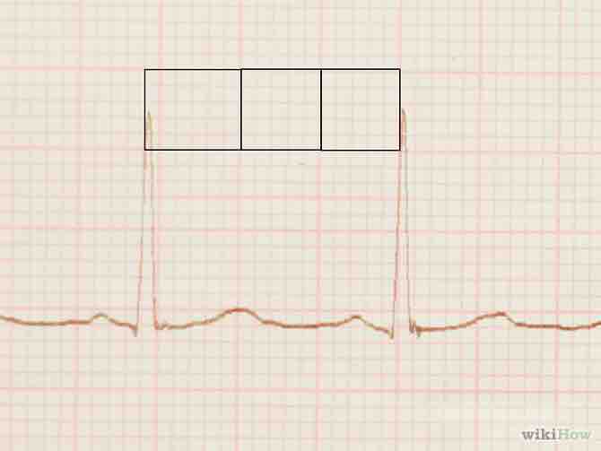 Imagen titulada Read an EKG Step 4