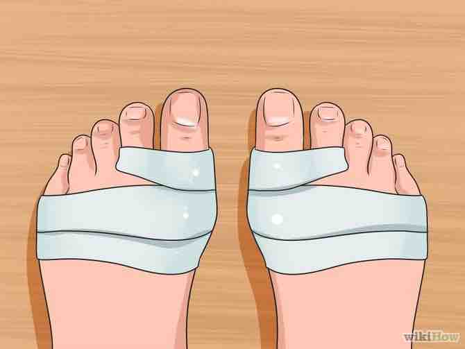 Imagen titulada Get Rid of Bunions Step 6