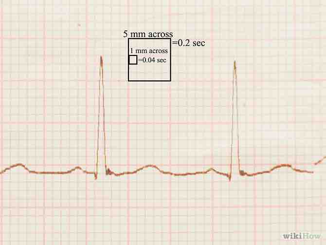 Imagen titulada Read an EKG Step 2