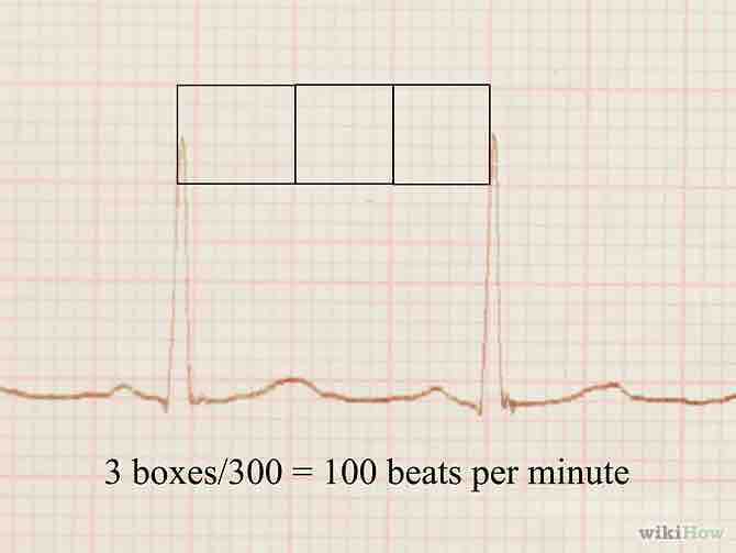 Imagen titulada Read an EKG Step 5