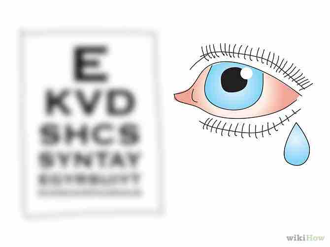 Imagen titulada Treat Pink Eye (Conjunctivitis) Step 1