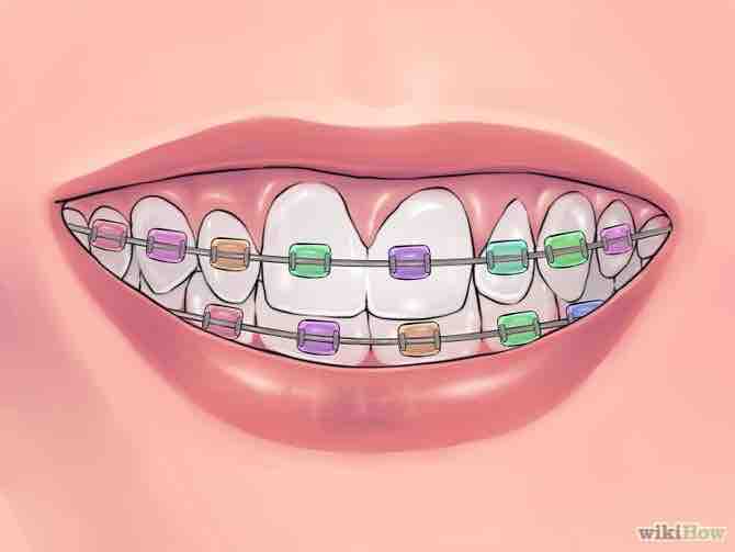 Imagen titulada Deal with Braces Step 18